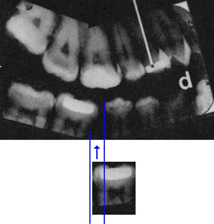 x-ray_fit_tooth.jpg