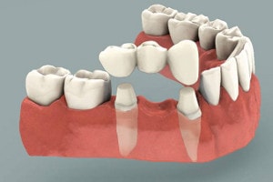 dental_bridge.jpg